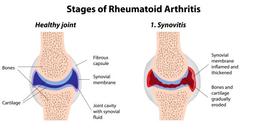 Dieta para artritis reumatoide pdf